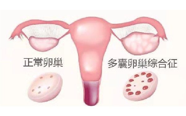 重度宫腔粘连患者通过手术治疗后做试管婴儿能成功吗